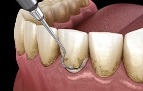 Illustration of scaling & root planing