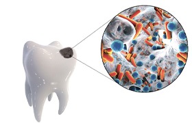 Image showing bacteria causing a cavity.