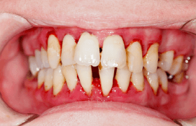 mouth with gum disease